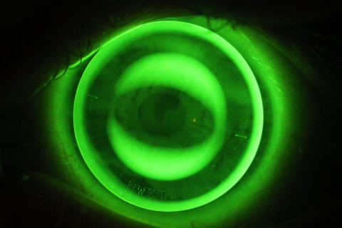 Astigmatism and EyeSpace® Forge Ortho-K™ (FRG2)