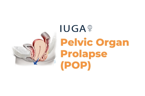 Pelvic Organ Prolapse