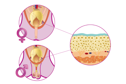A case of idiopathic cystitis
