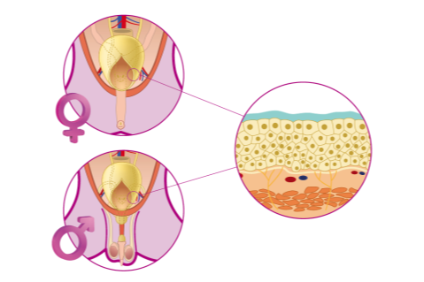 A case of idiopathic cystitis