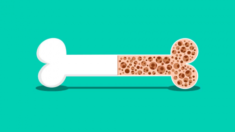 An Overview of Osteoporosis