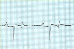 1st degree atrioventricular block