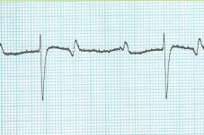 2nd degree atrioventricular block